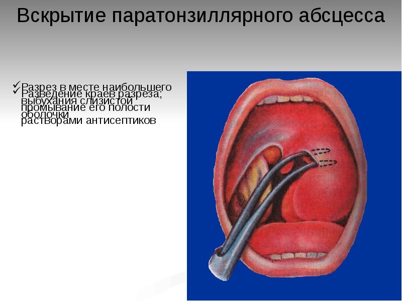 Паратонзиллярный абсцесс карта вызова скорой медицинской помощи