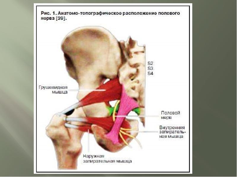 Воспаление полового нерва. Ущемление полового нерва.