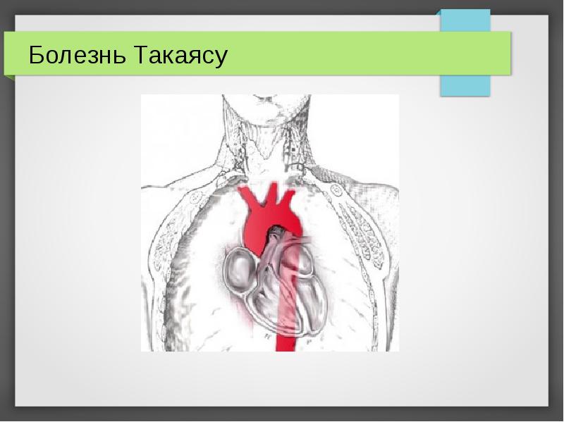 Болезнь Такаясу Болезнь Такаясу