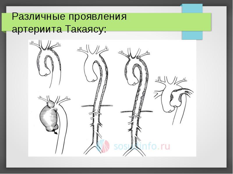 Синдром такаясу презентация