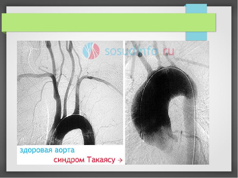 Синдром такаясу презентация