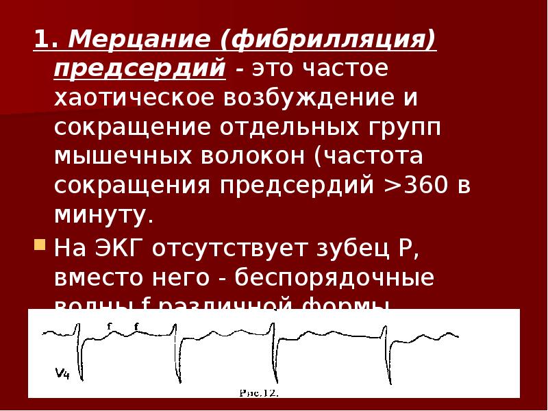 Волны при трепетании предсердий