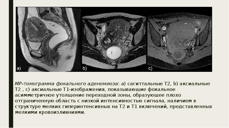 Мр картина аденомиоза