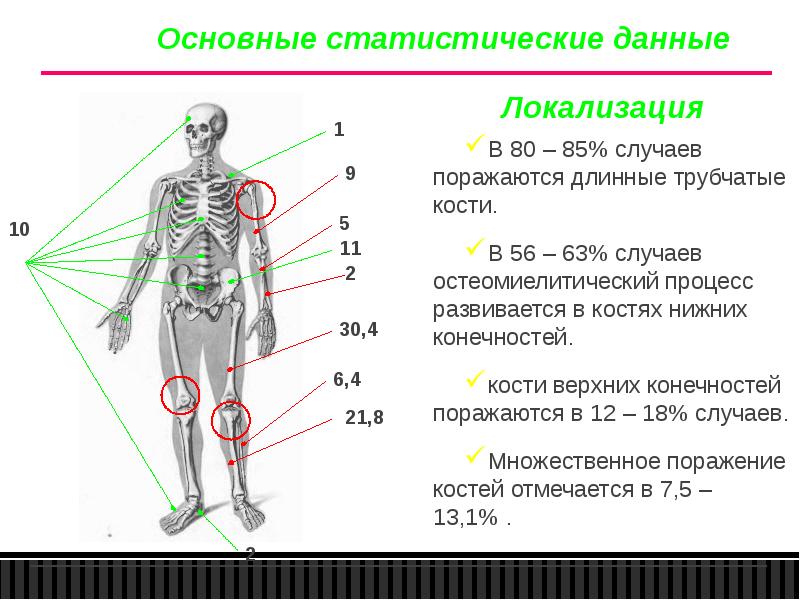 Частая локализация. Остеомиелит частая локализация. Наиболее частая локализация остеомиелита у детей. Остеомиелит пальцев стопы мкб 10. Почему у детей чаще поражаются трубчатые кости.