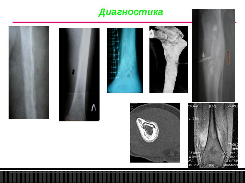 Гематогенный остеомиелит фото