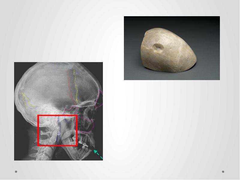 Презентация на тему перелом костей черепа thumbnail