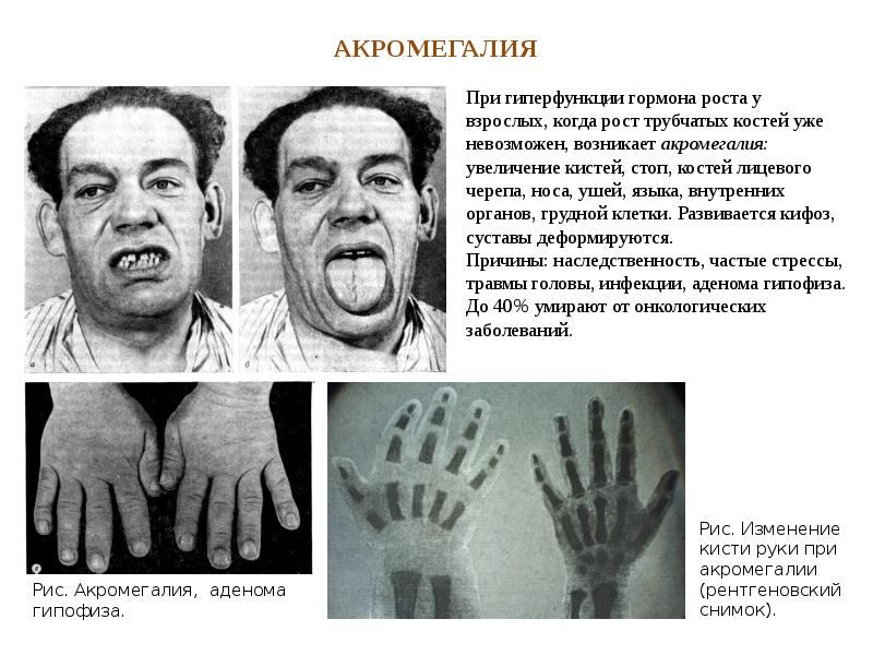 Диагностика акромегалии презентация