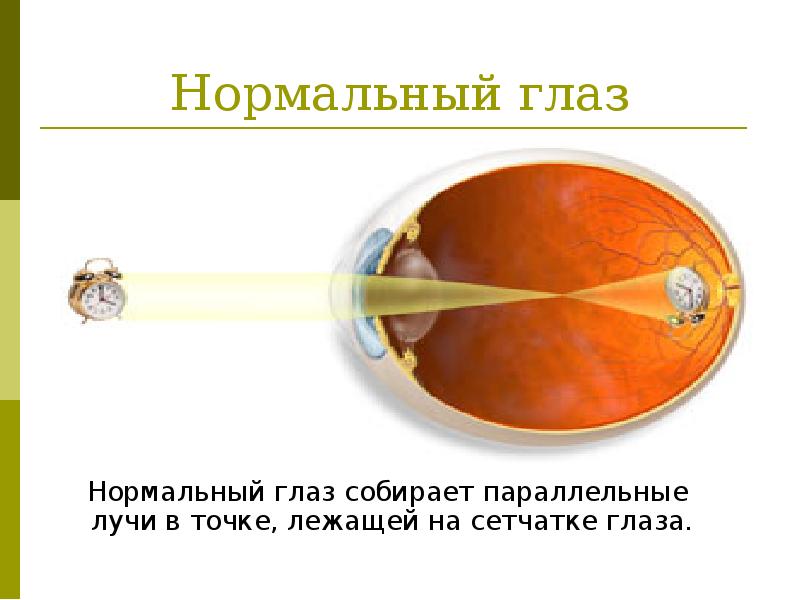 На сетчатке возникает изображение уменьшенное обратное уменьшенное прямое