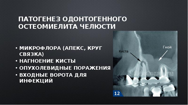 Клиническая картина острого одонтогенного остеомиелита челюсти заключается