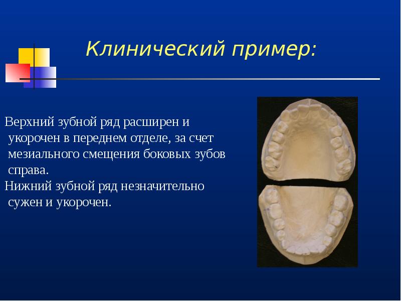 Сужено укорочено. Мезиальное смещение боковых зубов. Мезиальное положение зуба. Мезиальный наклон зуба.