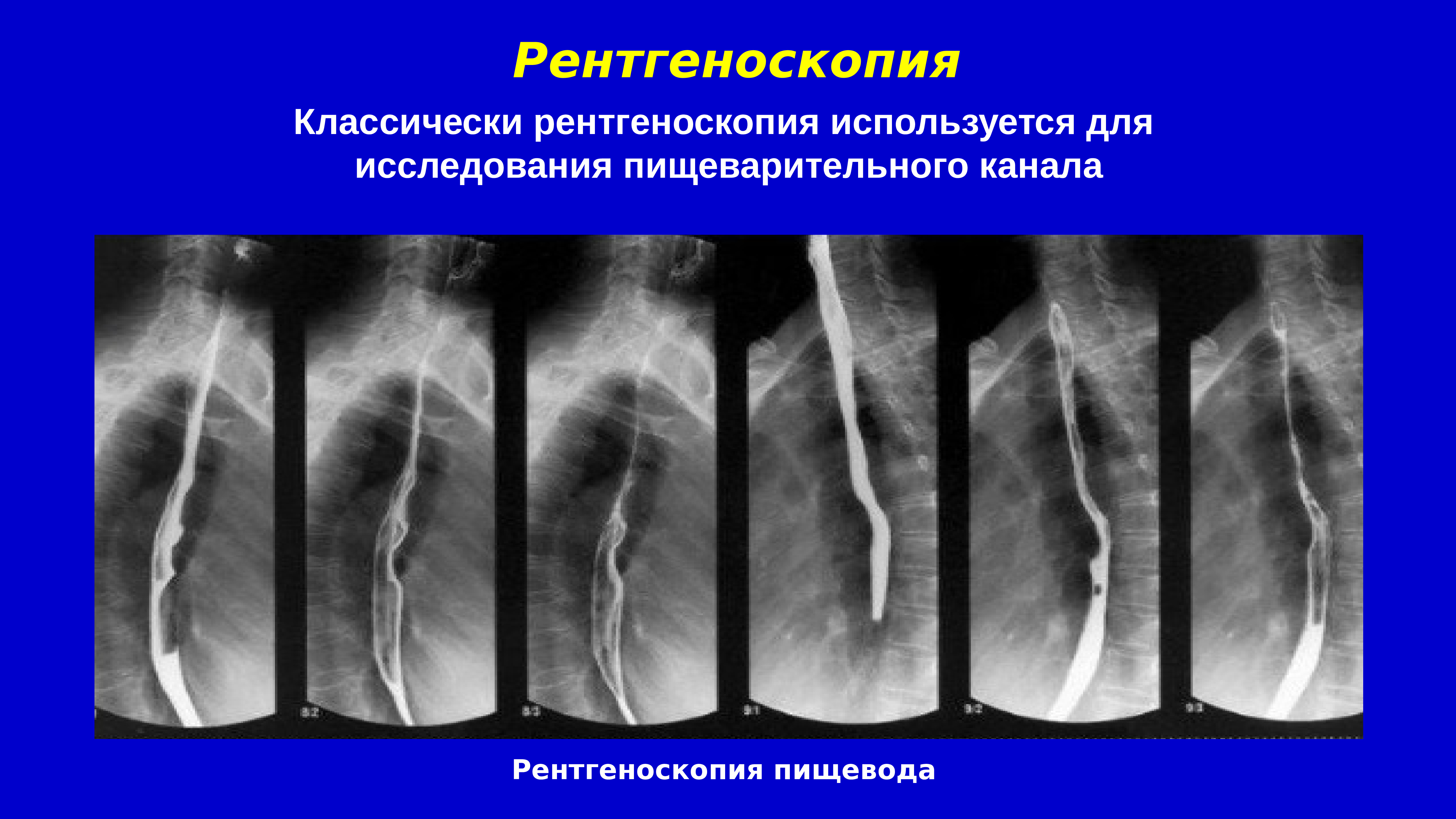 При рентгеноскопии изображение получается