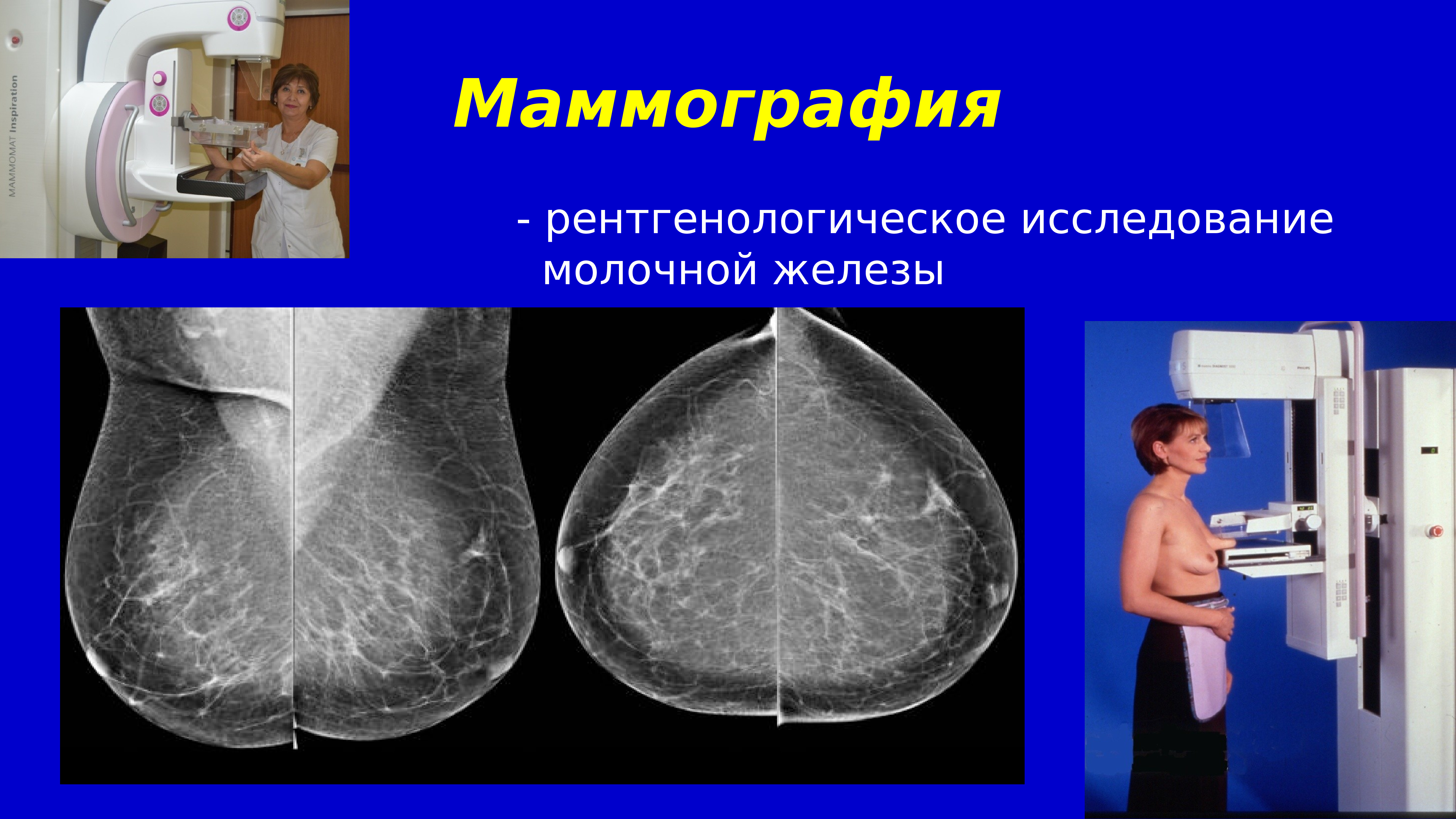 как делают маммографию груди у женщин фото 58