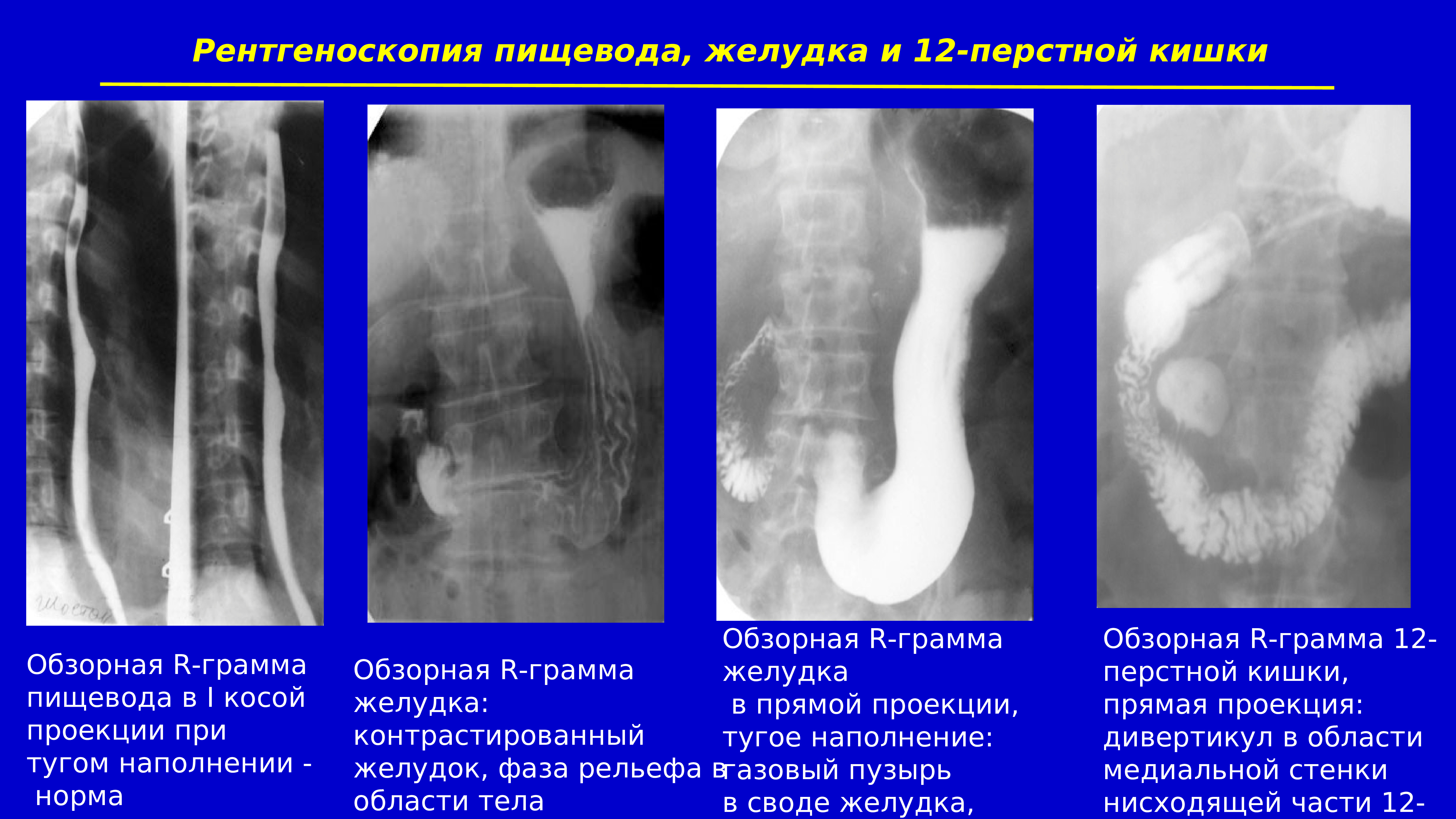 Рентгеноскопия пищевода и желудка с барием. Рентгеноскопия желудка и 12 перстной кишки. Рентген исследования желудка и 12 перстной кишки. Рентген пищевода желудка и 12-перстной кишки. Рентгенологическое исследование пищевода, желудка, 12-перстной кишки..