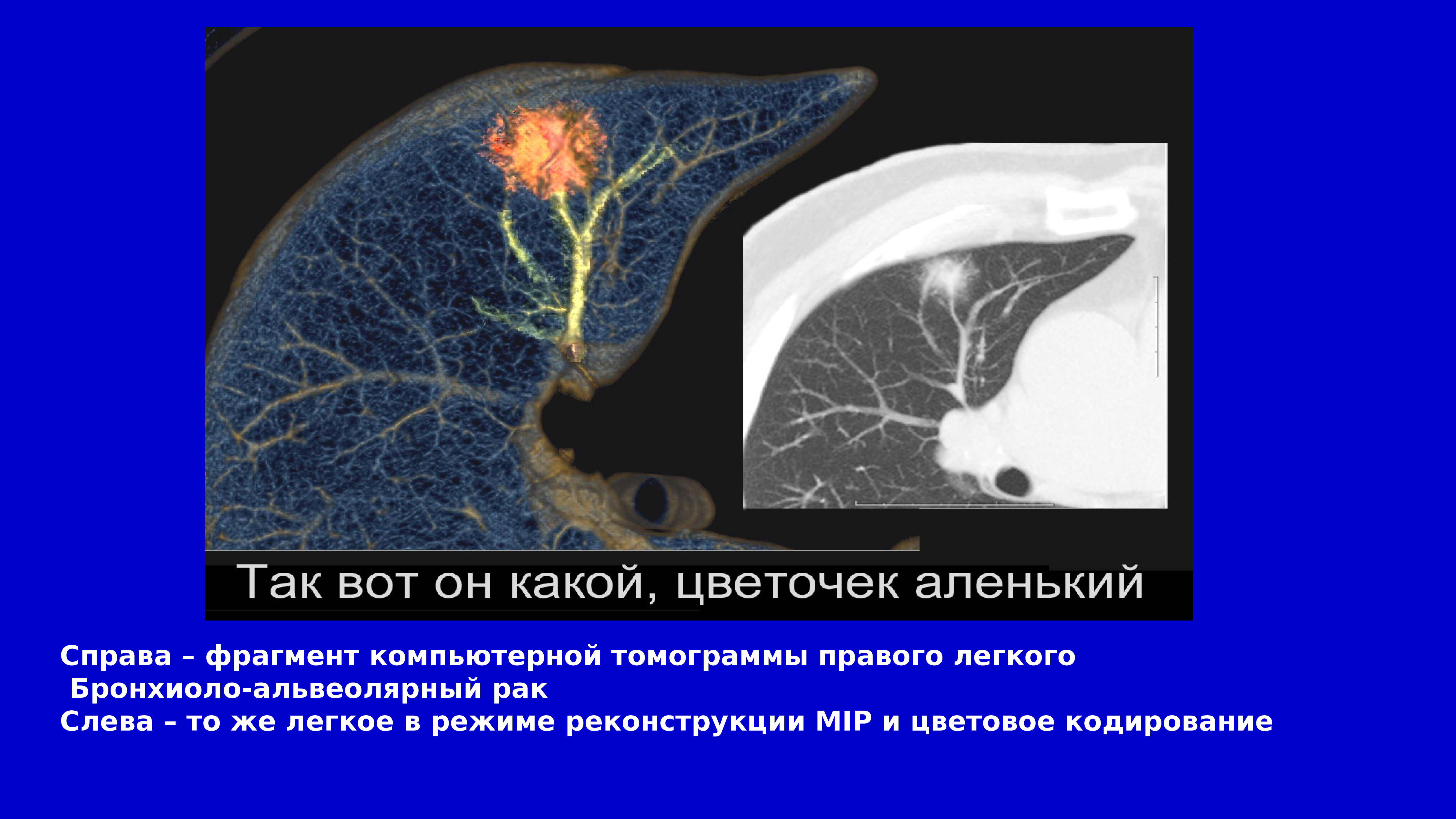 Рак легкого диагностика презентация