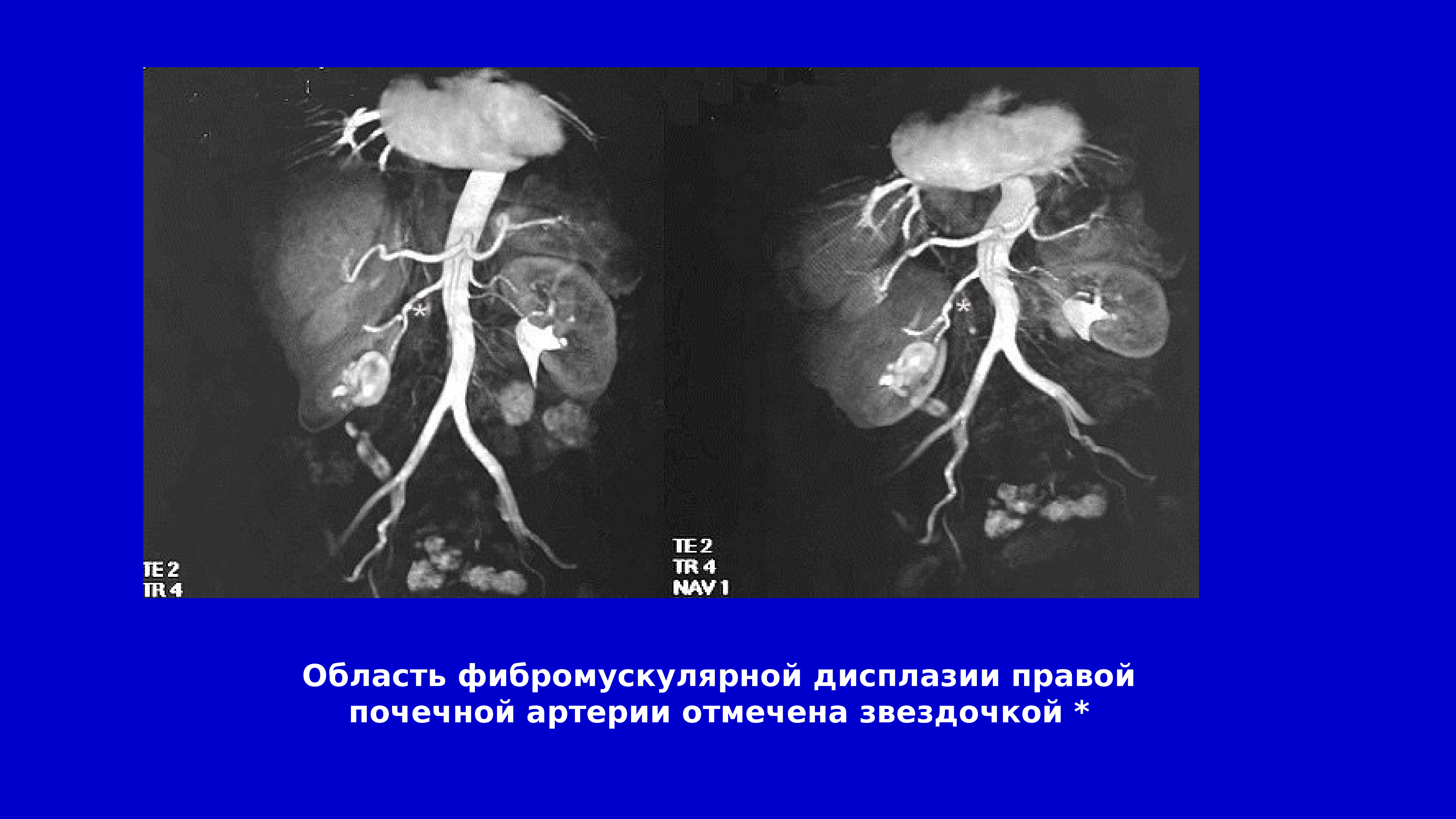 Дисплазия почки презентация