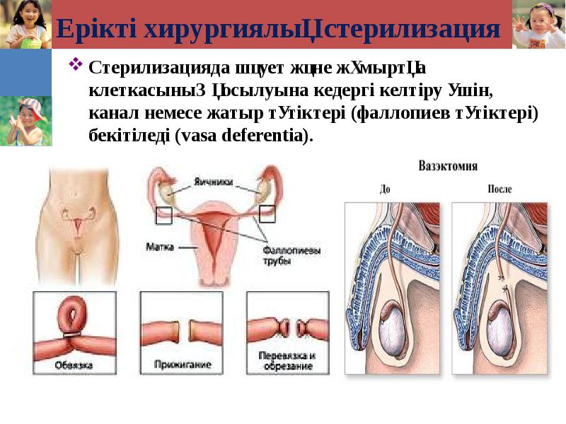 Ерікті хирургиялық стерилизация Стерилизацияда шәует және жұмыртқа клеткасының қосылуына кедергі келтіру
