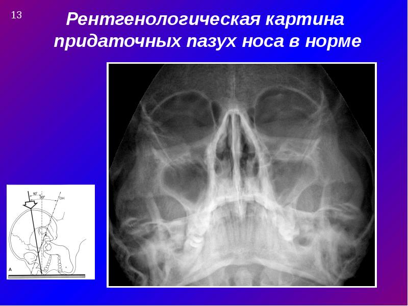 Одонтогенный гайморит презентация