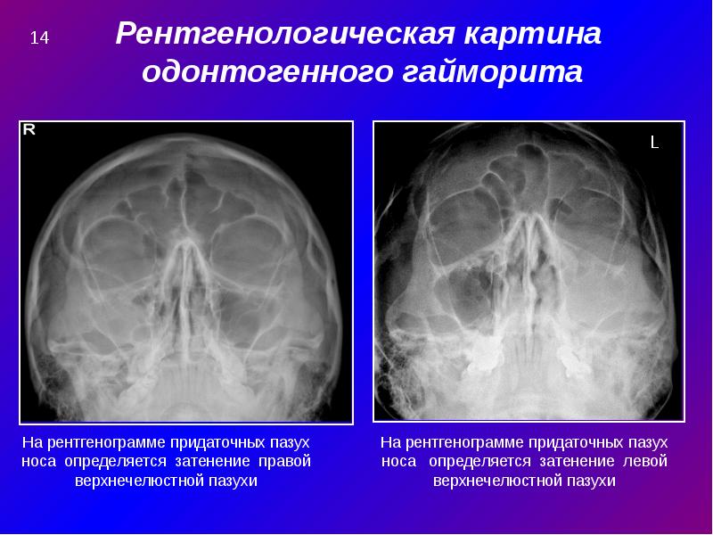 Одонтогенный гайморит презентация