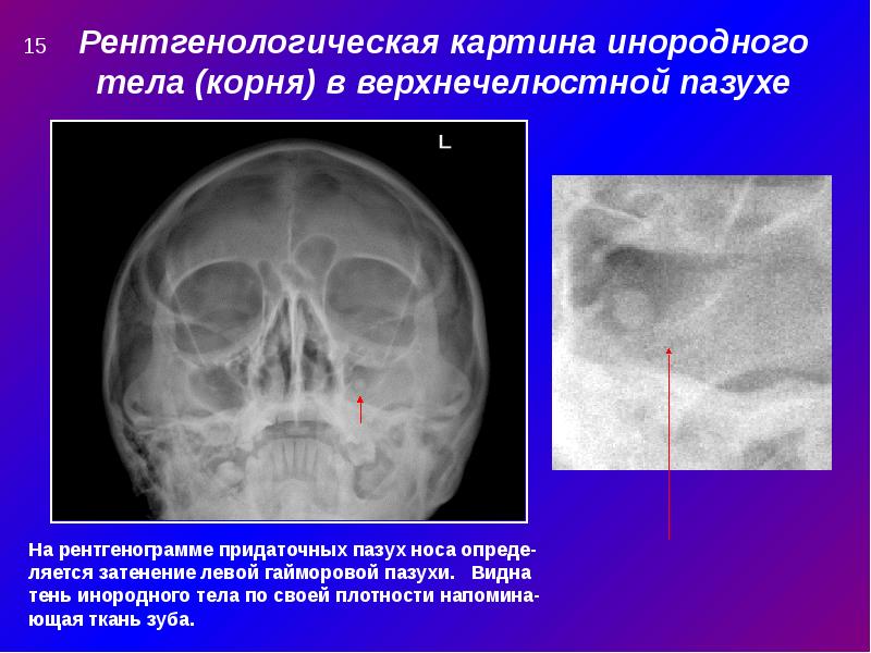 Верхнечелюстной синусит презентация