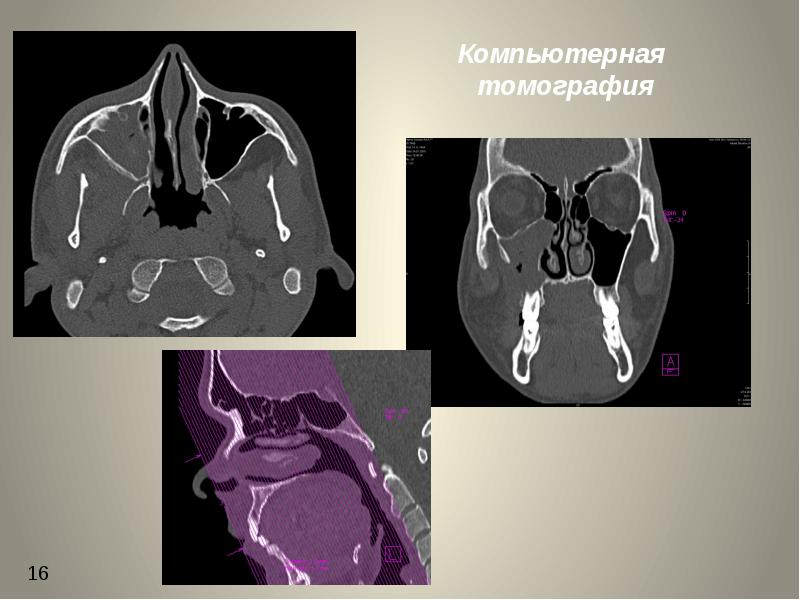 Одонтогенный верхнечелюстной синусит презентация