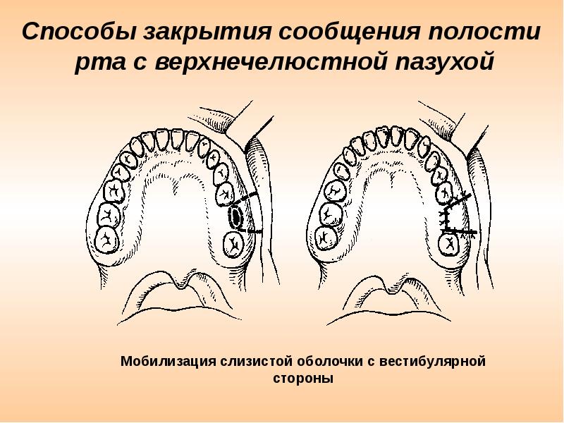 Одонтогенный гайморит презентация