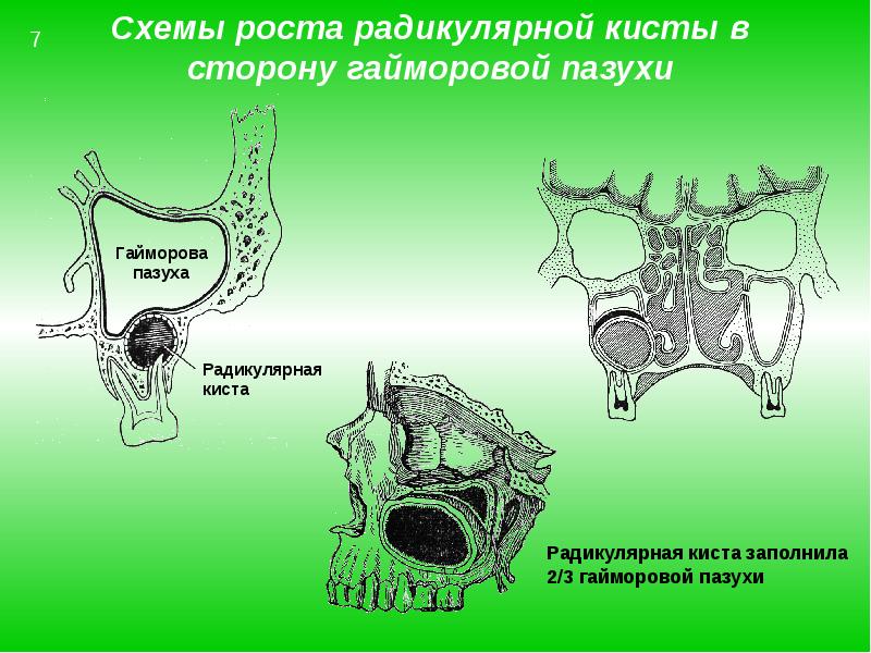 Одонтогенный гайморит презентация