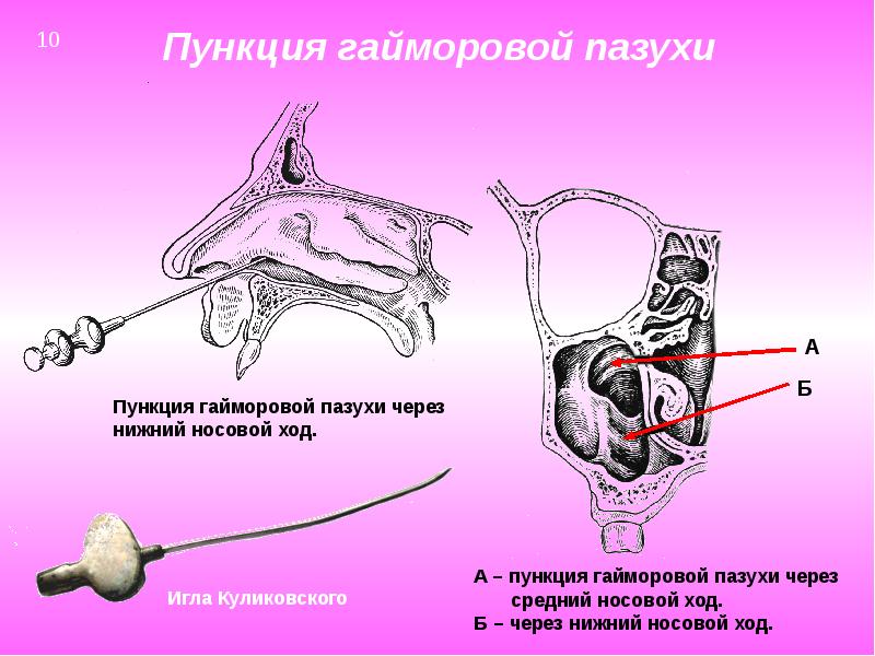 Одонтогенный гайморит презентация