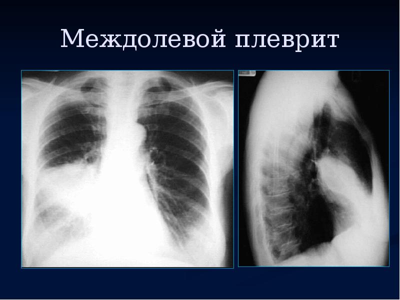 Почему на рентгеновском снимке изображение газа в плевральной полости черное