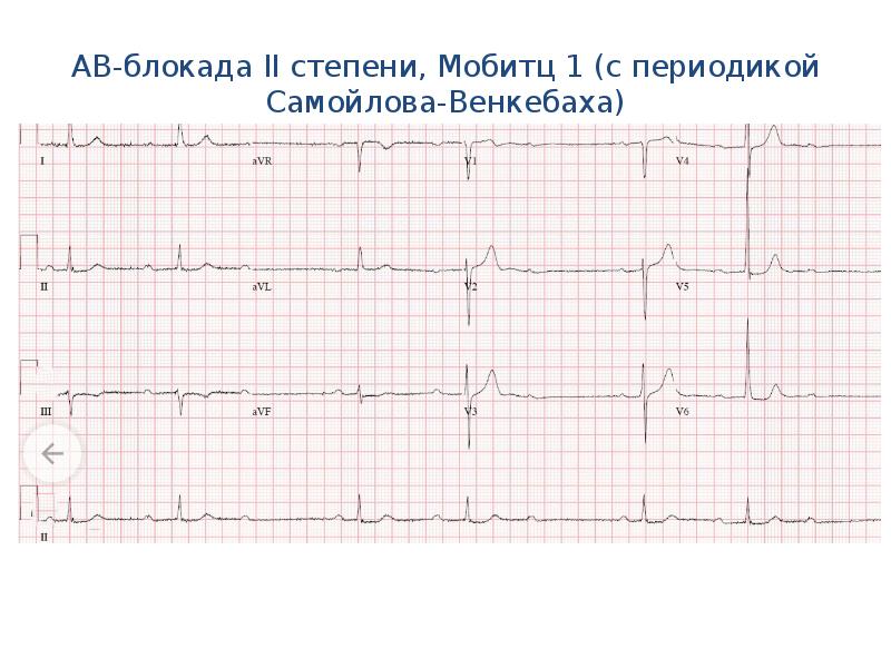 Ав блокада 2. Блокада Мобитц 1 на ЭКГ. АВ блокада 2ст Мобитц 3. A-V блокада II степени с периодикой Самойлова-Векенбаха. Мобиц 1 и Мобиц 2 на ЭКГ.