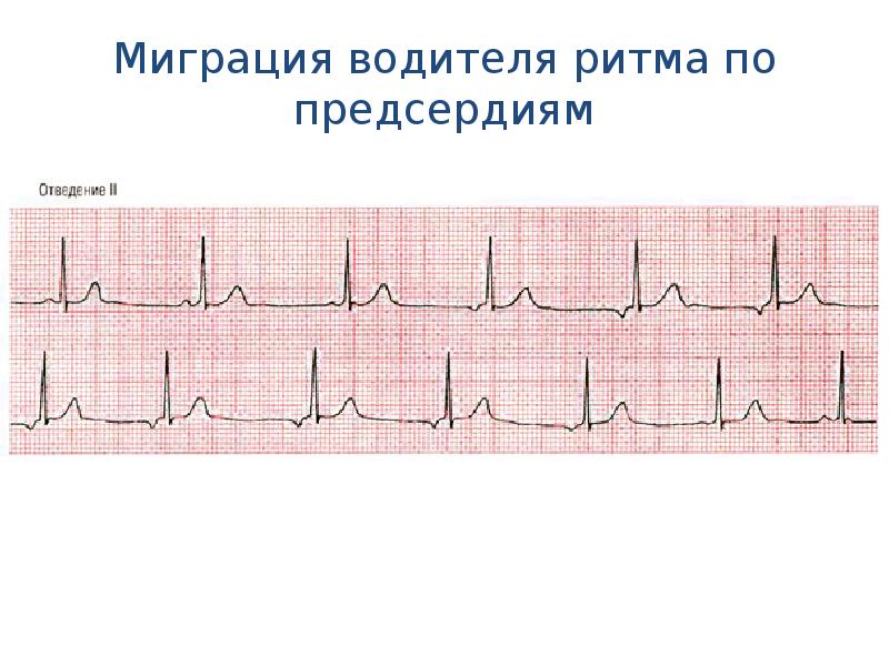 Миграция водителя ритма. Миграция наджелудочкового водителя ритма на ЭКГ. Миграция суправентрикулярного водителя ритма по предсердиям. Миграция суправентрикулярного водителя ритма на ЭКГ. Миграция суправентрикулярного водителя ритма на ЭКГ ЧСС 55.