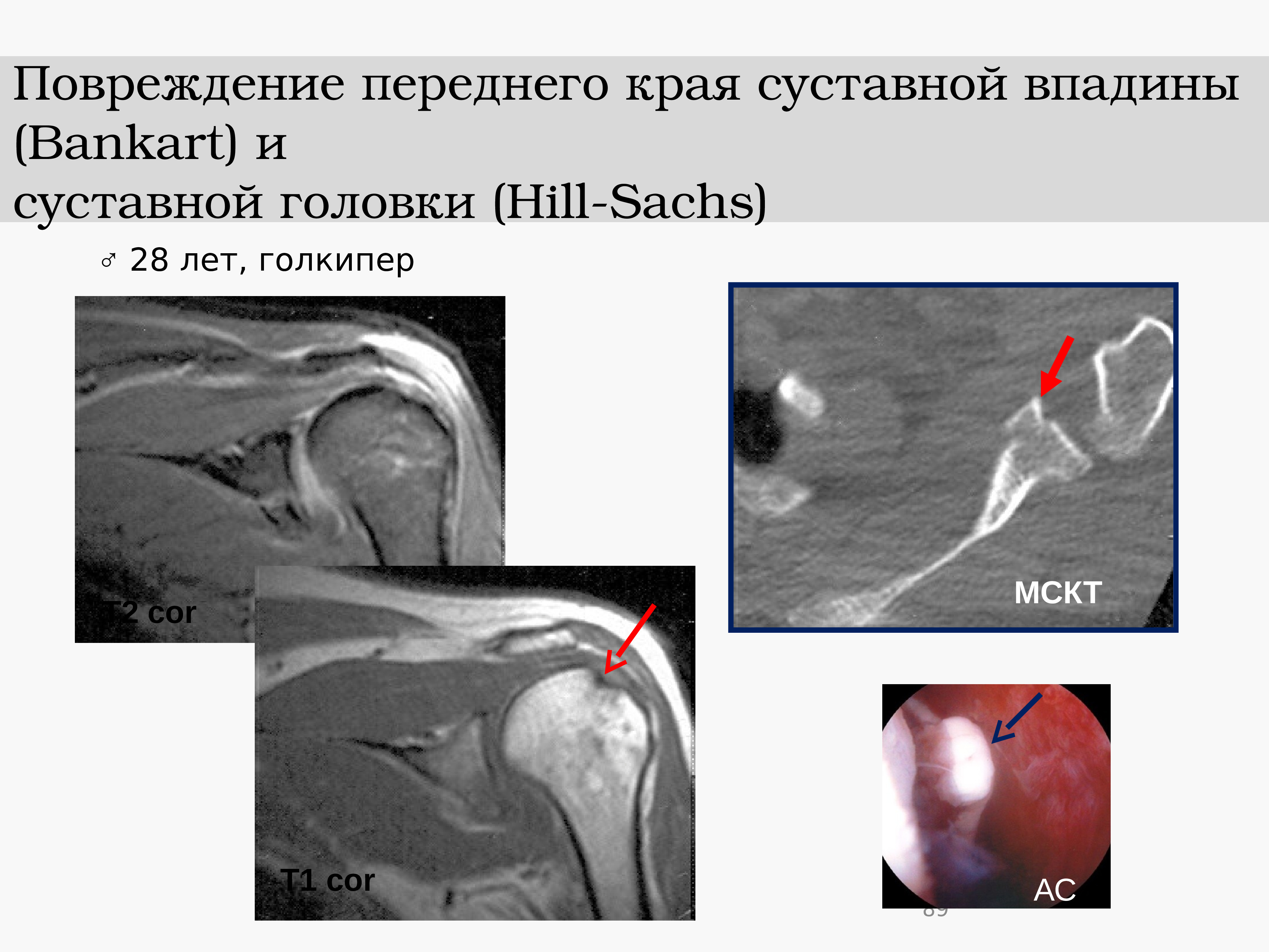 Повреждение хилл сакса мрт. Перелом хилл-сакса плечевой кости кт. Хилл сакса плечевого сустава мрт. Хилл сакса плечевого сустава мрт. Повреждение хилл сакса мрт.