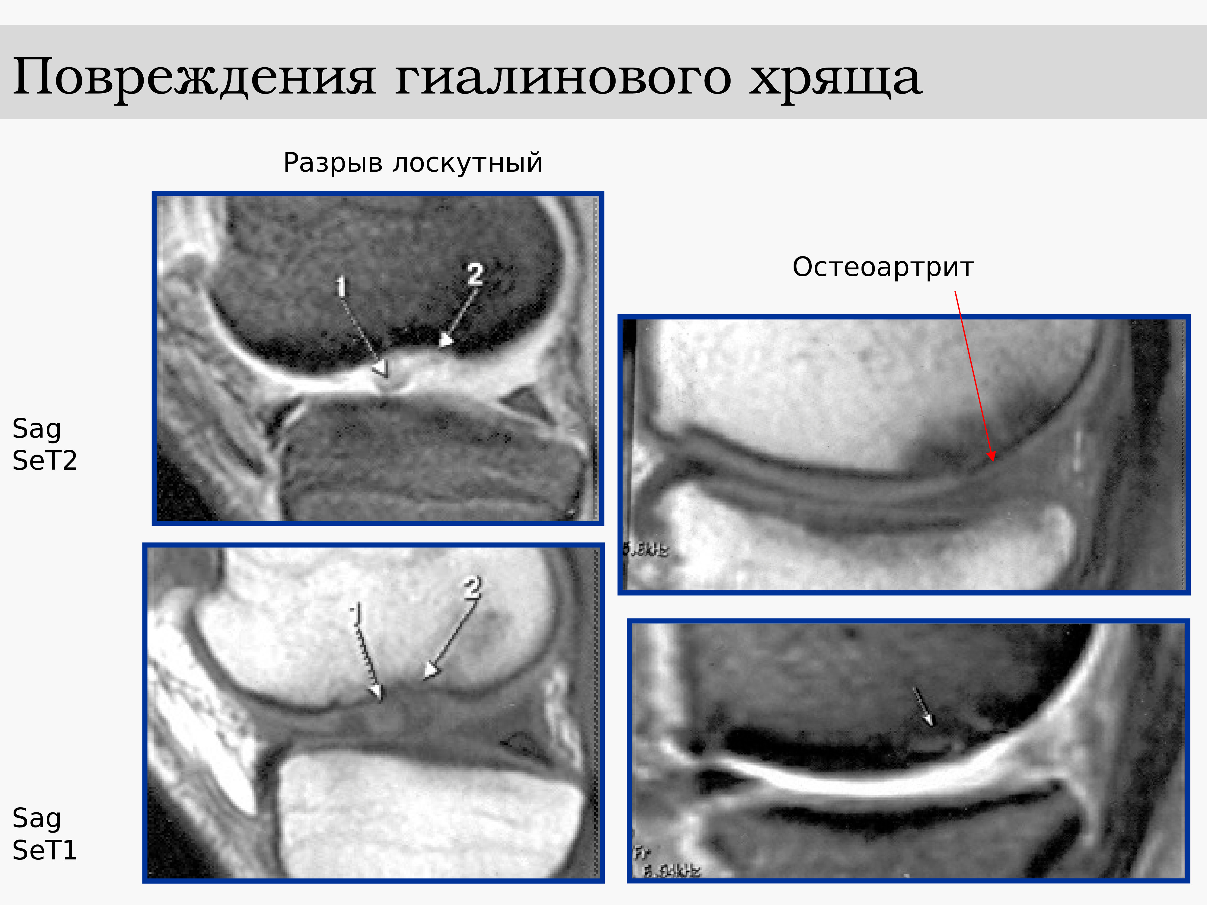 хрящи человека фон. деформирующий остеоартрит коленного сустава. деформирующий остеоартроз коленного сустава (гонартроз). повреждение хряща. разрыв суставного хряща коленного.