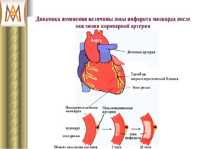 Коронарная недостаточность презентация