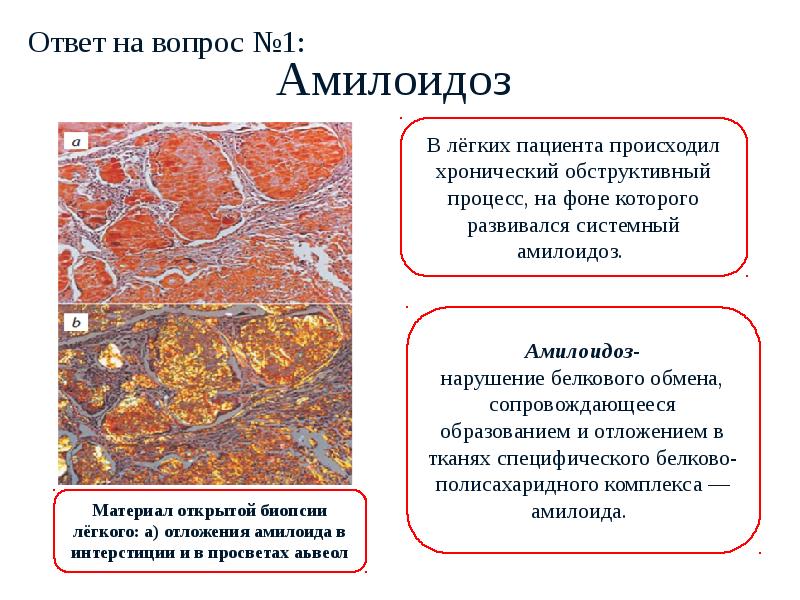 Транстиретиновый амилоидоз что это за болезнь. Этиология амилоидоза патанатомия. Амилоидоз почек микроскопия. Классификация амилоидоза патанатомия. Вторичный амилоидоз патанатомия.