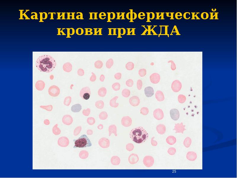 Картина крови при анемии