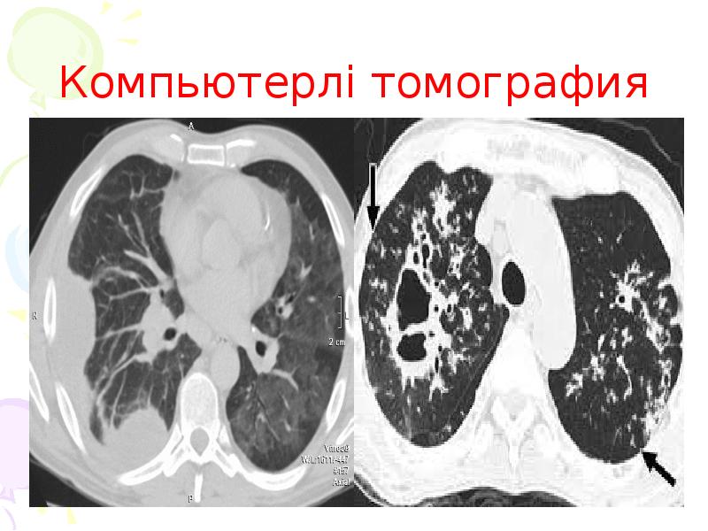 Компьютерлі томография