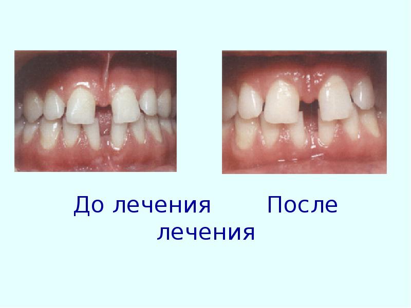 Профилактика зубочелюстных аномалий презентация