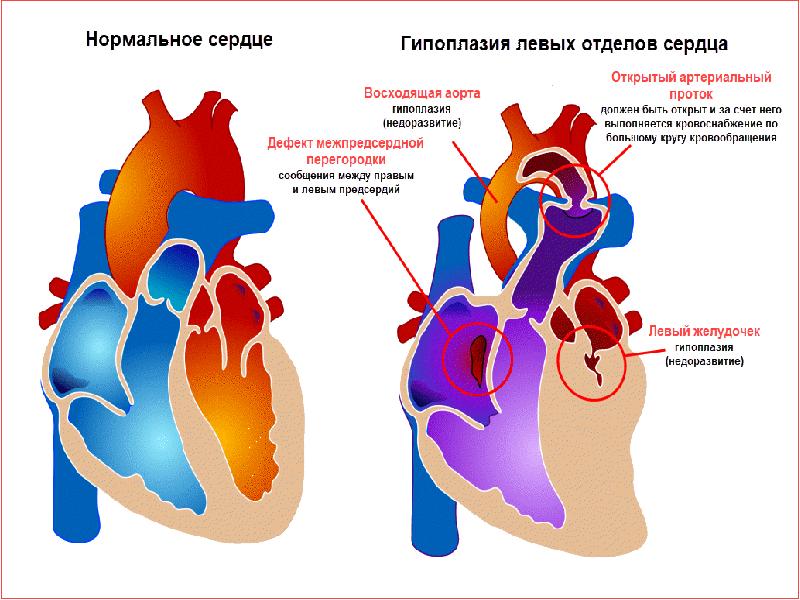 Гипоплазия восходящей аорты