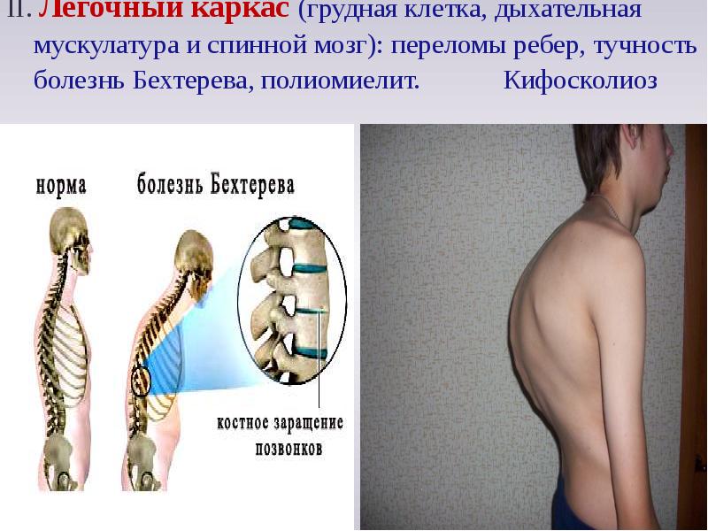 Кифосколиоз. Кифосколиоз (болезнь Шейермана-МАУ). Кифосколиолитическая грудная клетка. Кифосколиотическоегрудная клетка. Кифосколиоз грудной клетки.