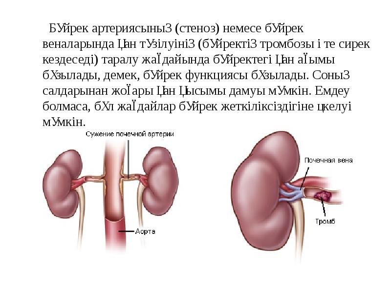 Бүйрек коликасы презентация