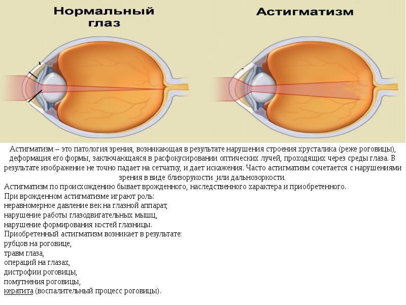 Астигматизм это. Строение глаза астигматизм. Что такое астигматизм зрения. Врожденный астигматизм. Астигматизм схема глаза.