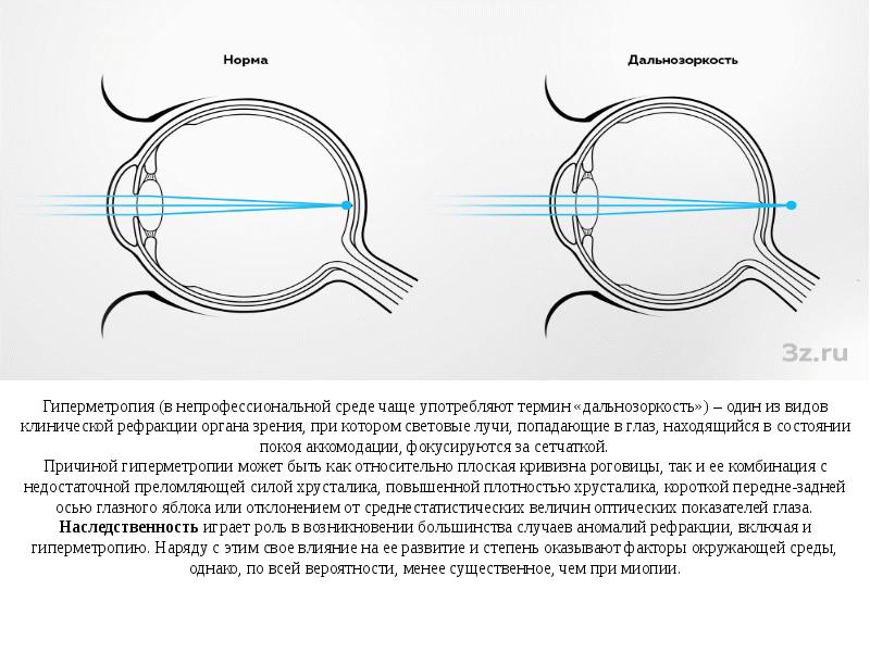 Операция при дальнозоркости. Аномалии рефракции миопия гиперметропия астигматизм. Аномалии рефракции глаза близорукость дальнозоркость астигматизм. Схемы рефракции при нормальном зрении при миопии при гиперметропии. Аномалии рефракции глаза анатомия.