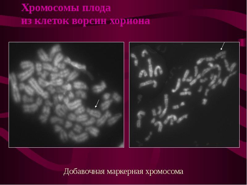 Сколько хромосом в яйцеклетках шимпанзе. Исследование клеток ворсин хориона это. Добавочные хромосомы. Кариотип маркерная хромосома.