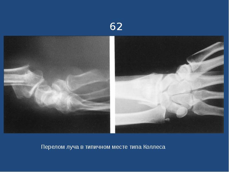 Перелом смита и колеса презентация