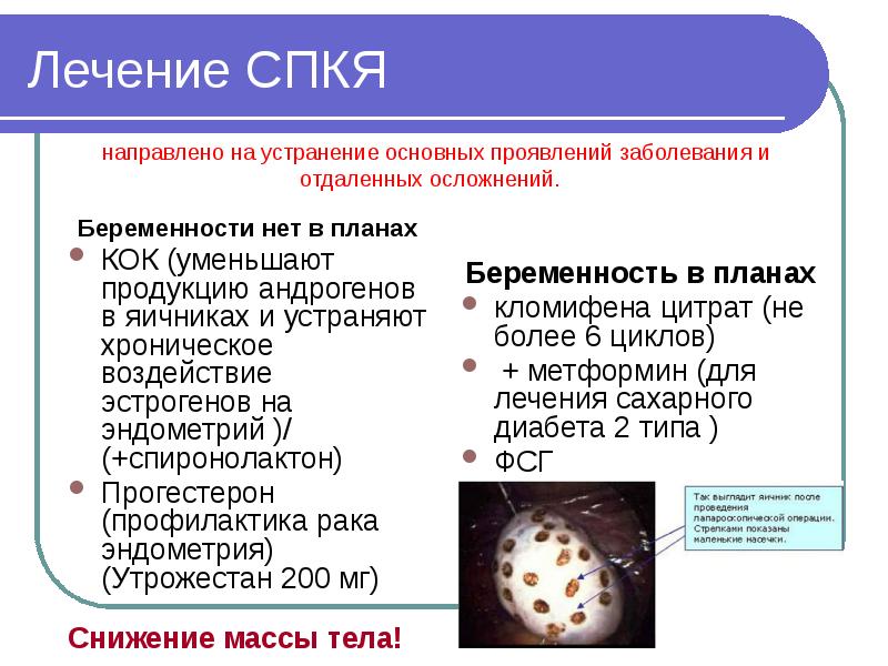 Синдром поликистозных яичников презентация