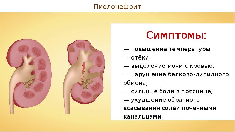 Патология мочевыделительной системы презентация