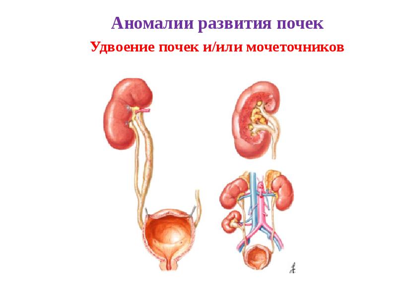 Аномалия развития почек презентация