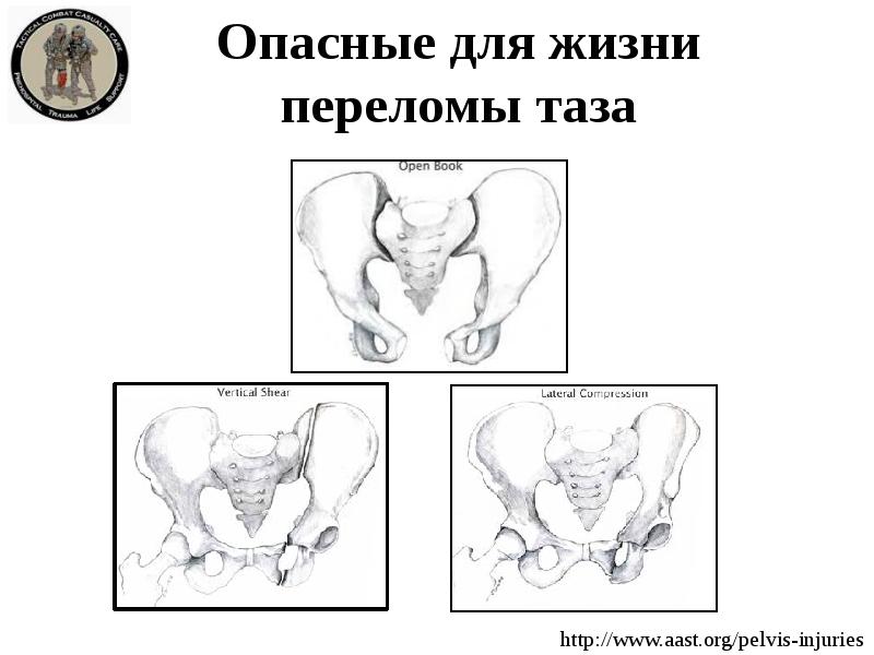 Переломы таза презентация