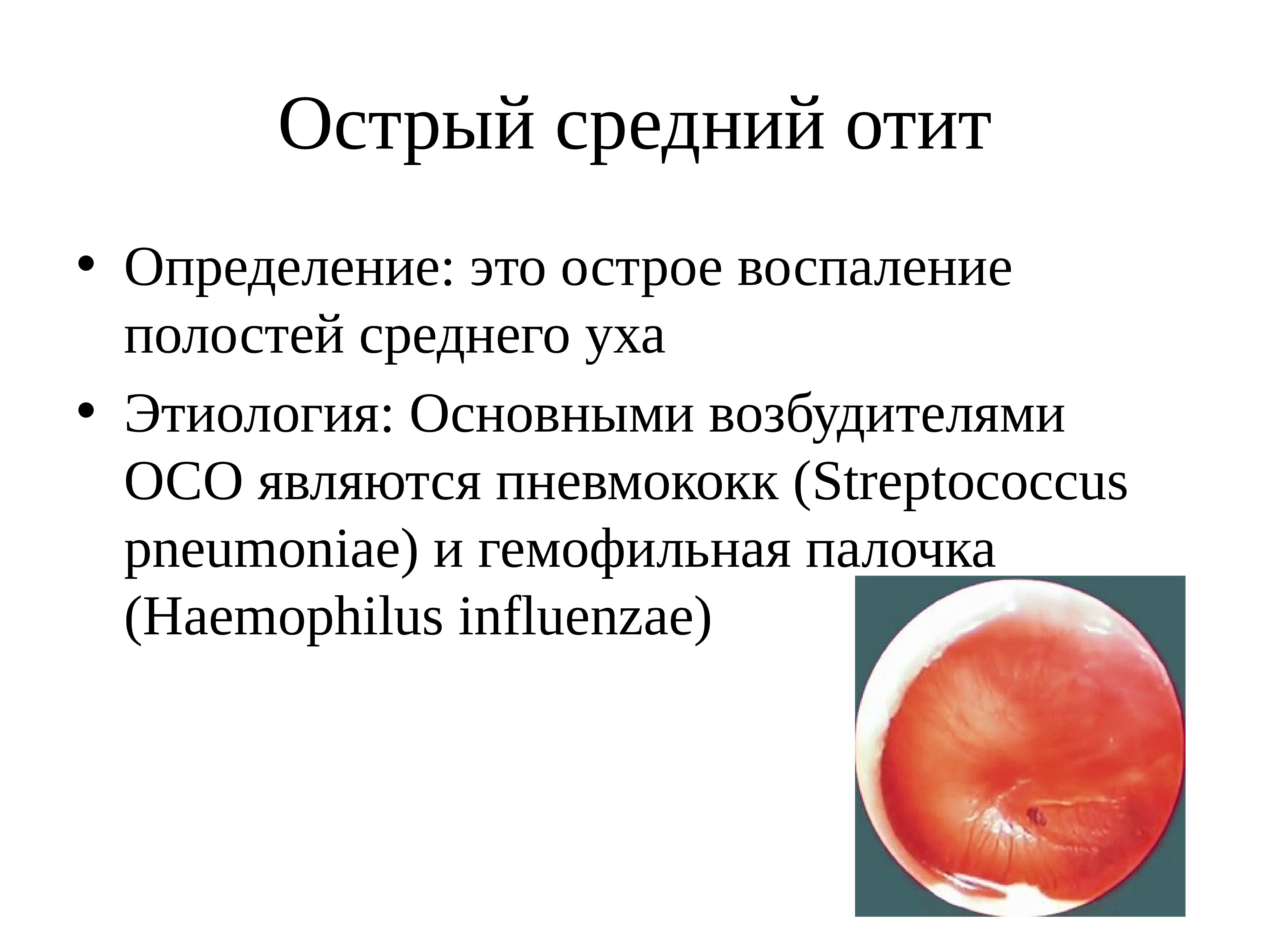 Стадии острого гнойного среднего отита. Симптомы острого гнойного среднего отита. Острый гнойный средний отит лечение. Лечение острого гнойного среднего отита. Стадии острого гнойного среднего отита.