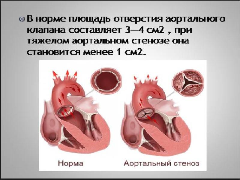 Аортальный стеноз что это такое. Кальцинированный аортальный стеноз. Амиодарон аортальный стеноз. Кальцинированный аортальный стеноз рисунки.